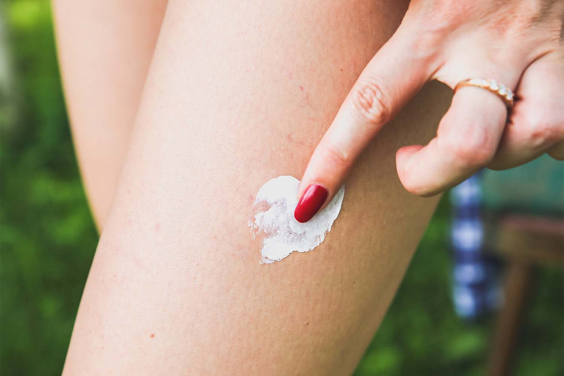 Best Anti-Itch Cream For Bug Bites